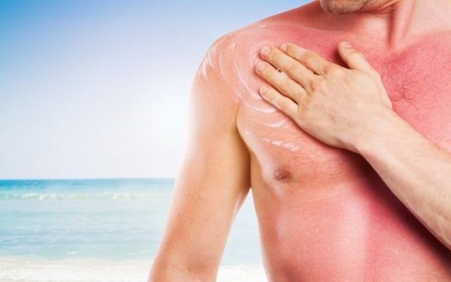 Man treating sunburn